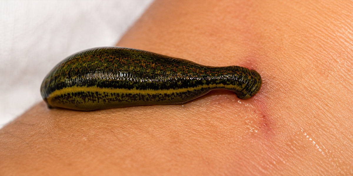 LEECH THERAPY (JALOOKA) – Ayurvedic Blood Purification
